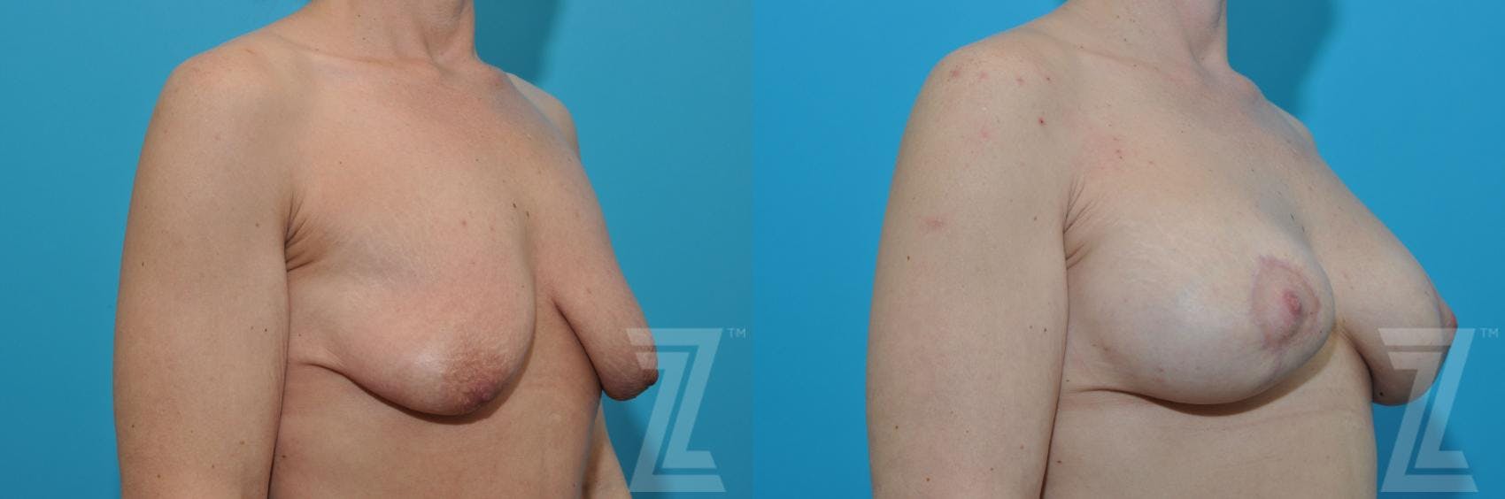 Breast Augmentation With a Breast Lift Before & After Gallery - Patient 132791127 - Image 4
