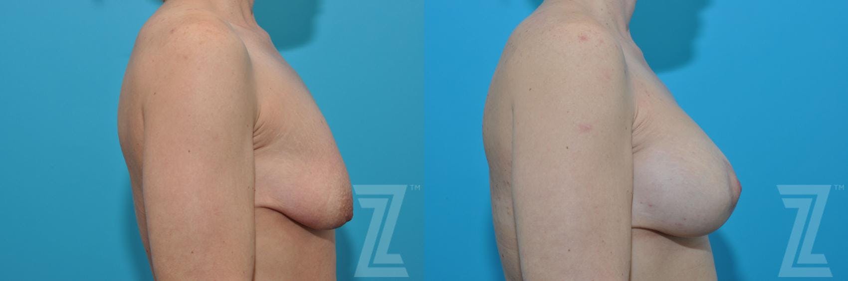Breast Augmentation With a Breast Lift Before & After Gallery - Patient 132791127 - Image 5