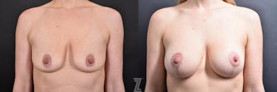 Austin Breast Augmentation With a Breast Lift Before & After Gallery - Patient 132791129 - Image 1 - The Piazza Center