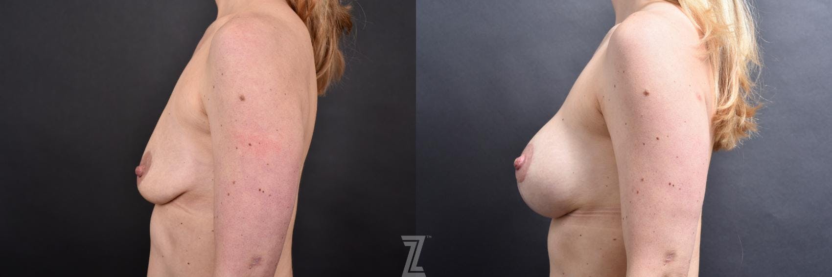 Breast Augmentation With a Breast Lift Before & After Gallery - Patient 132791129 - Image 3