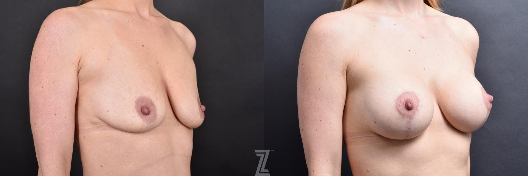 Breast Augmentation With a Breast Lift Before & After Gallery - Patient 132791129 - Image 4
