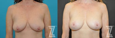 Austin Breast Augmentation With a Breast Lift Before & After Gallery - Patient 132791131 - Image 1 - The Piazza Center