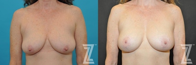 Breast Augmentation With a Breast Lift Before & After Gallery - Patient 132791131 - Image 1