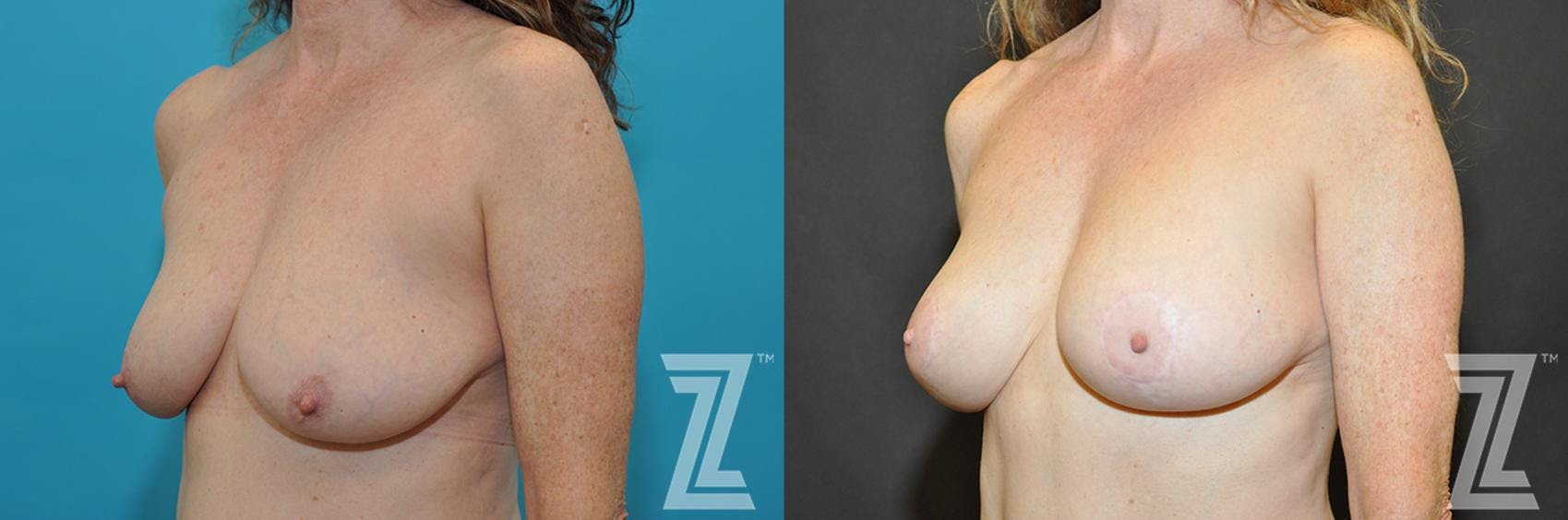 Breast Augmentation With a Breast Lift Before & After Gallery - Patient 132791131 - Image 2