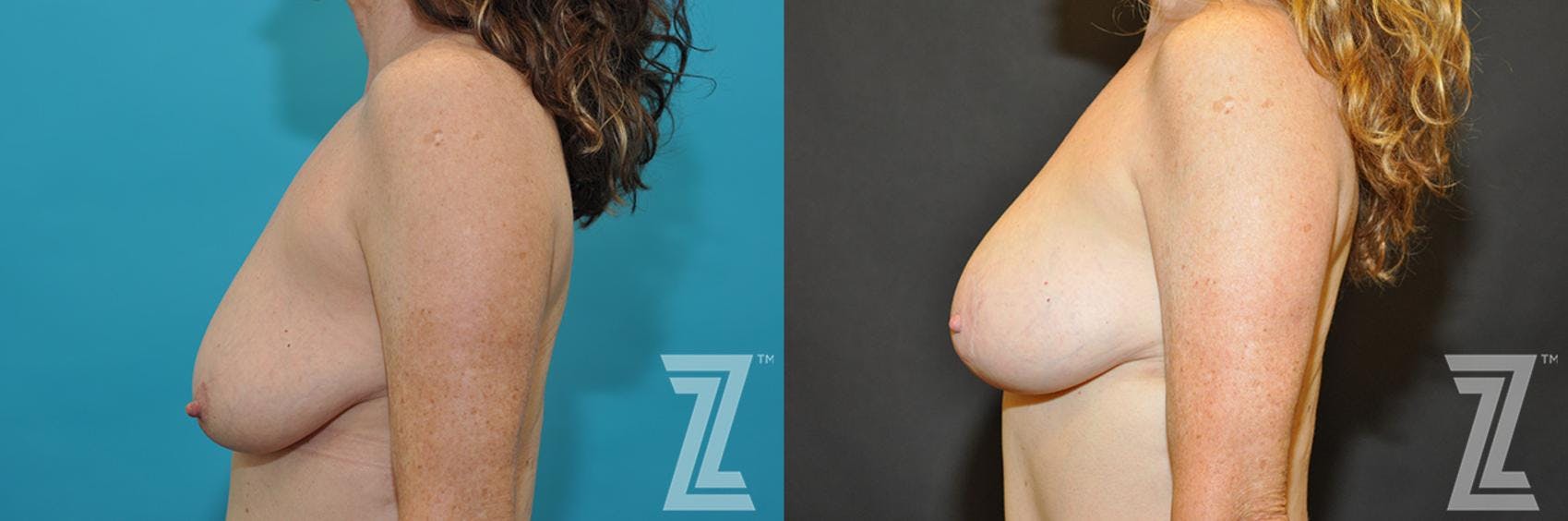 Breast Augmentation With a Breast Lift Before & After Gallery - Patient 132791131 - Image 3