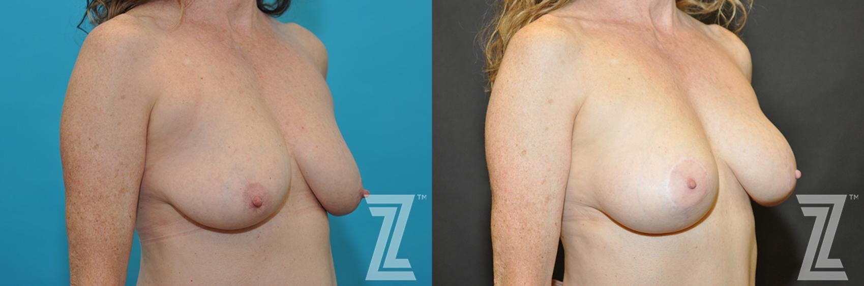 Breast Augmentation With a Breast Lift Before & After Gallery - Patient 132791131 - Image 4
