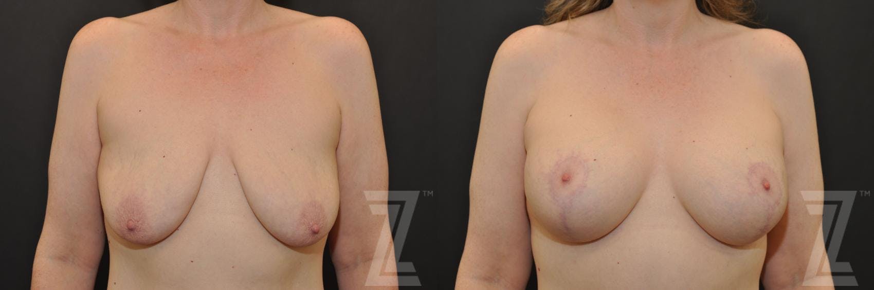 Breast Augmentation With a Breast Lift Before & After Gallery - Patient 132793338 - Image 1