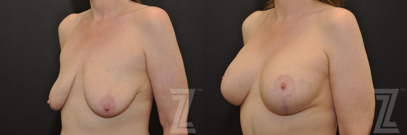 Breast Augmentation With a Breast Lift Before & After Gallery - Patient 132793338 - Image 2