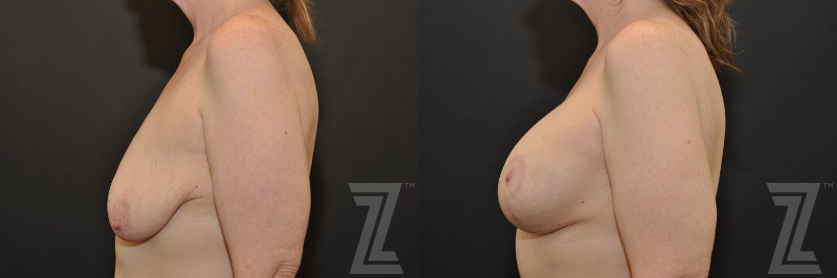 Breast Augmentation With a Breast Lift Before & After Gallery - Patient 132793338 - Image 3