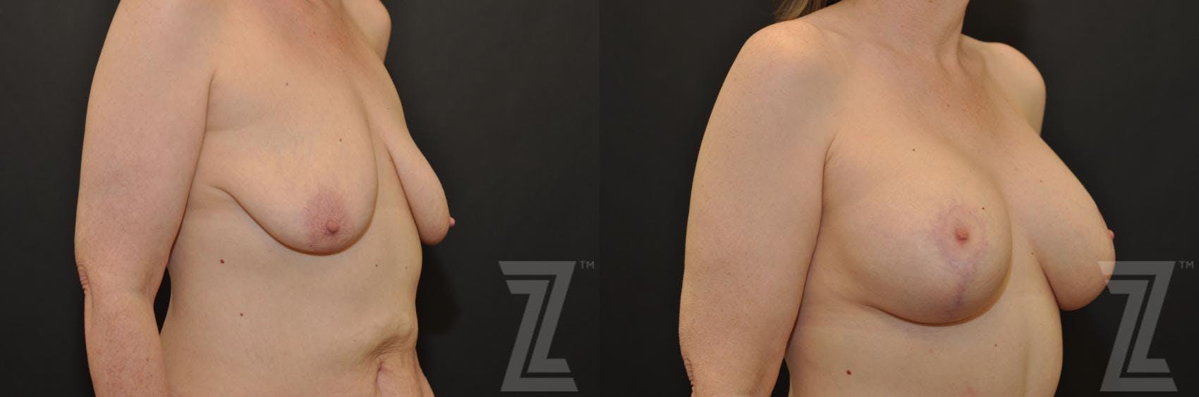 Breast Augmentation With a Breast Lift Before & After Gallery - Patient 132793338 - Image 4