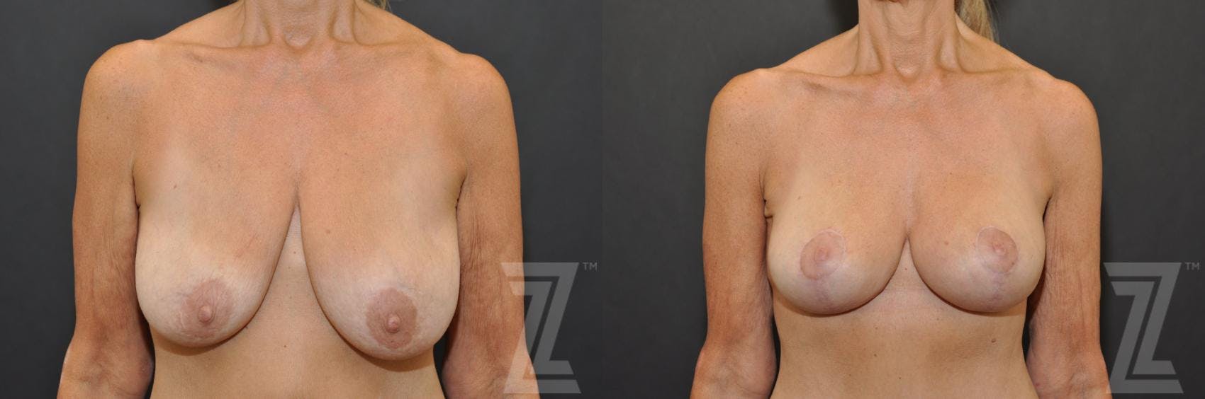 Breast Augmentation With a Breast Lift Before & After Gallery - Patient 132793339 - Image 1