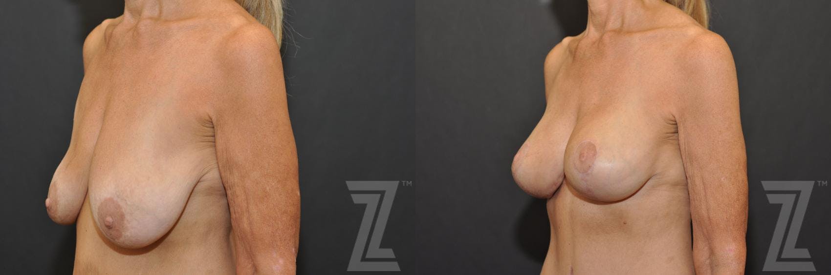 Breast Augmentation With a Breast Lift Before & After Gallery - Patient 132793339 - Image 2