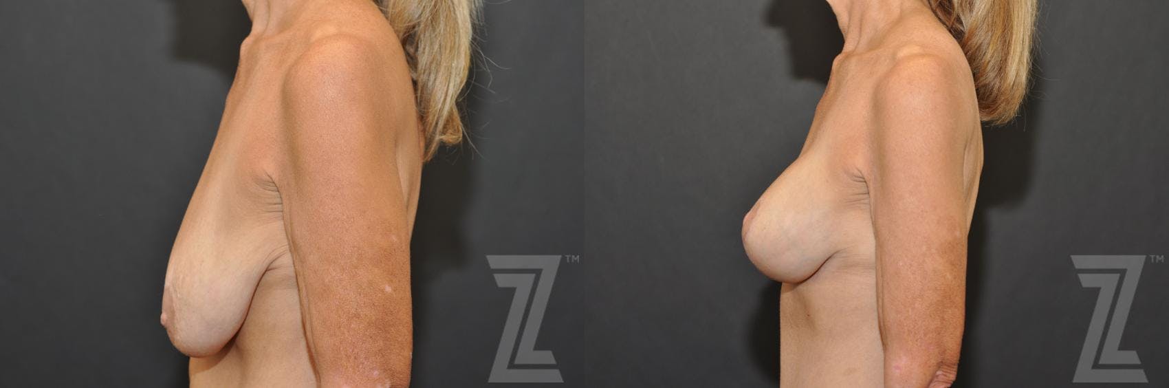 Breast Augmentation With a Breast Lift Before & After Gallery - Patient 132793339 - Image 3
