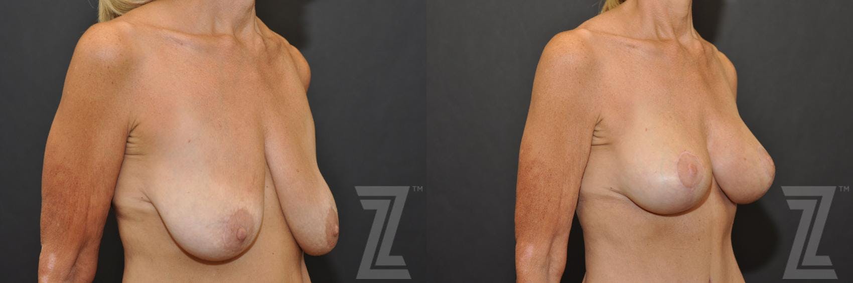 Breast Augmentation With a Breast Lift Before & After Gallery - Patient 132793339 - Image 4