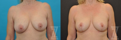 Breast Augmentation Revision Before & After Gallery - Patient 132793346 - Image 1