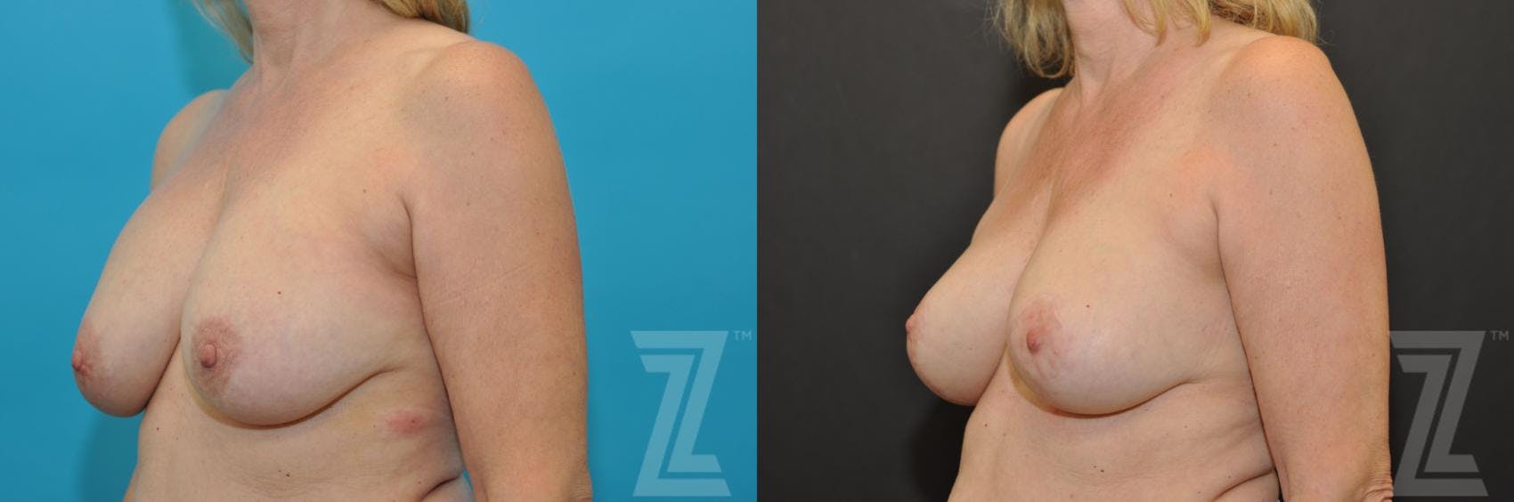 Breast Augmentation Revision Before & After Gallery - Patient 132793346 - Image 2