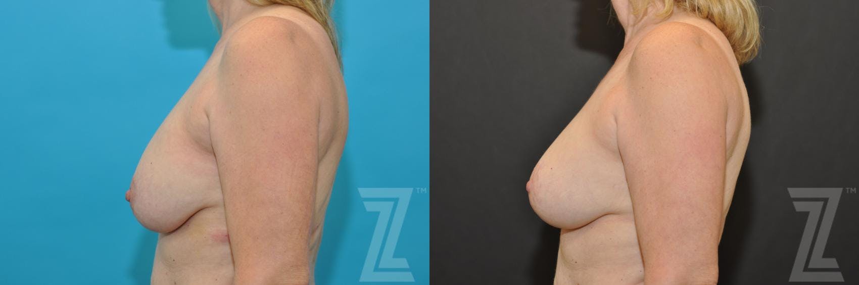 Breast Augmentation Revision Before & After Gallery - Patient 132793346 - Image 3