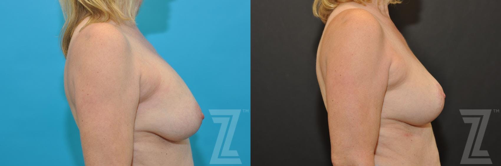 Breast Augmentation Revision Before & After Gallery - Patient 132793346 - Image 5
