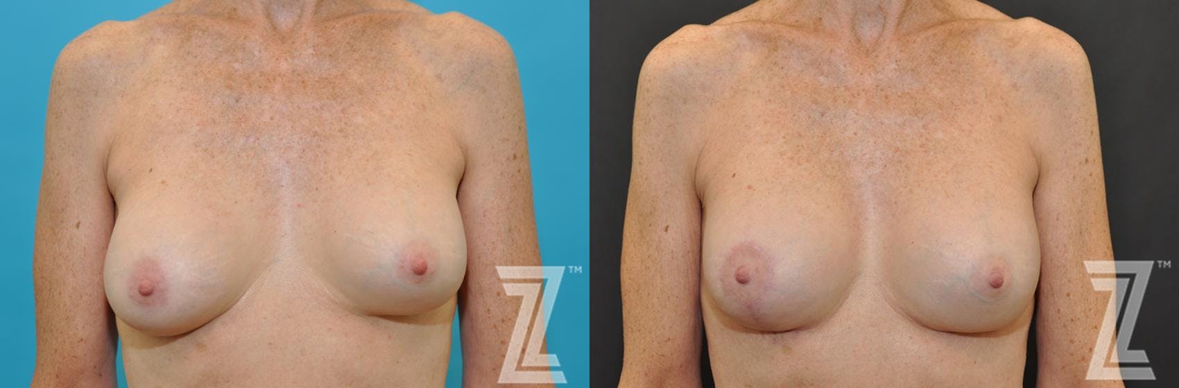 Breast Augmentation Revision Before & After Gallery - Patient 132793347 - Image 1