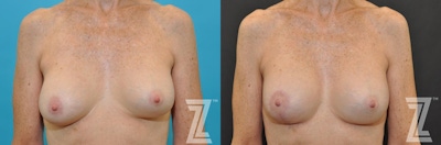 Breast Augmentation Revision Before & After Gallery - Patient 132793347 - Image 1