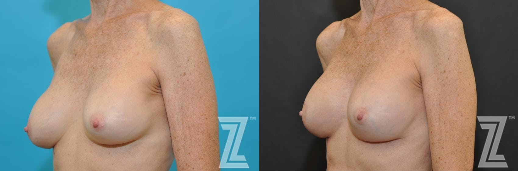 Breast Augmentation Revision Before & After Gallery - Patient 132793347 - Image 2