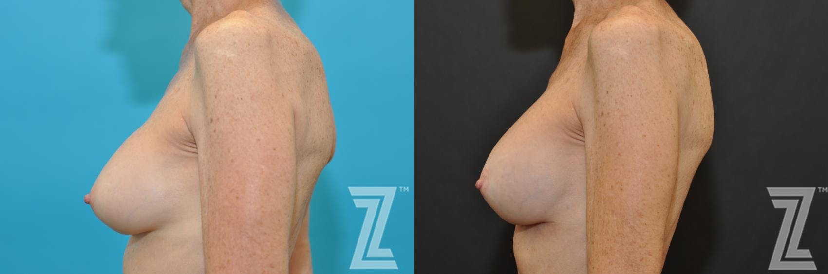 Breast Augmentation Revision Before & After Gallery - Patient 132793347 - Image 3