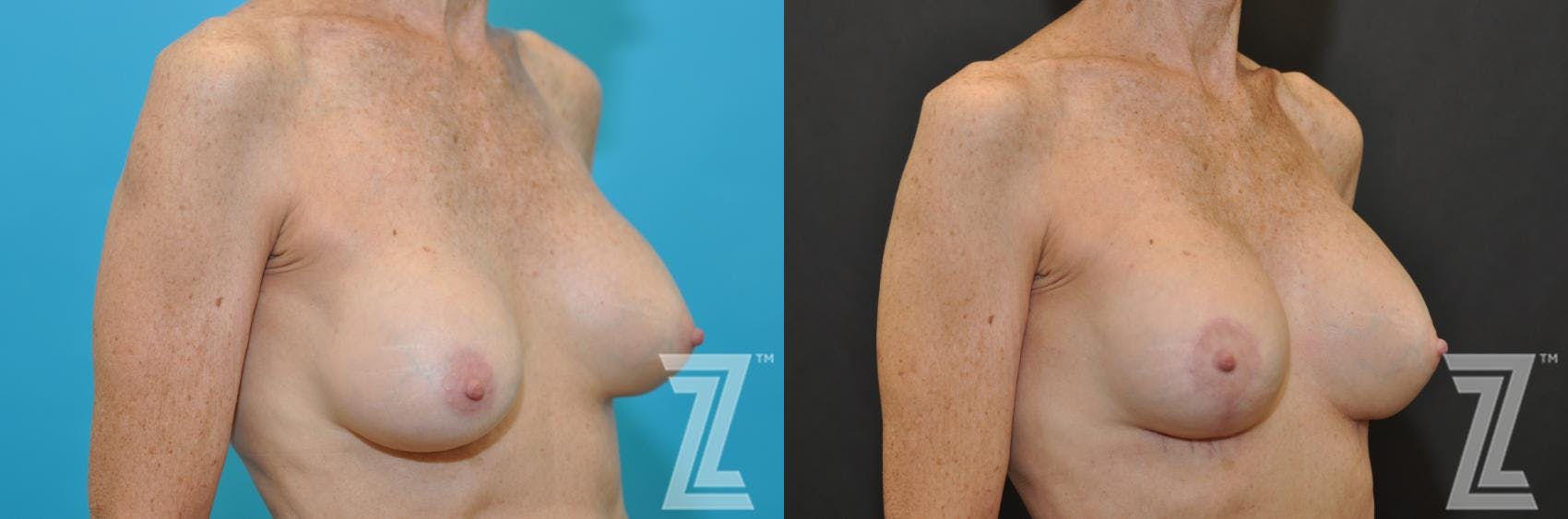 Breast Augmentation Revision Before & After Gallery - Patient 132793347 - Image 4