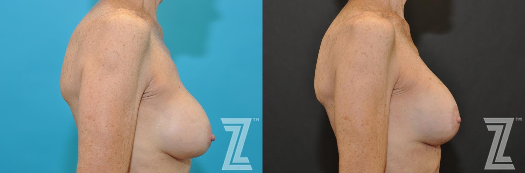 Breast Augmentation Revision Before & After Gallery - Patient 132793347 - Image 5