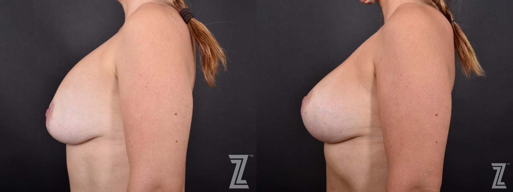 Breast Augmentation Revision Before & After Gallery - Patient 132793352 - Image 3