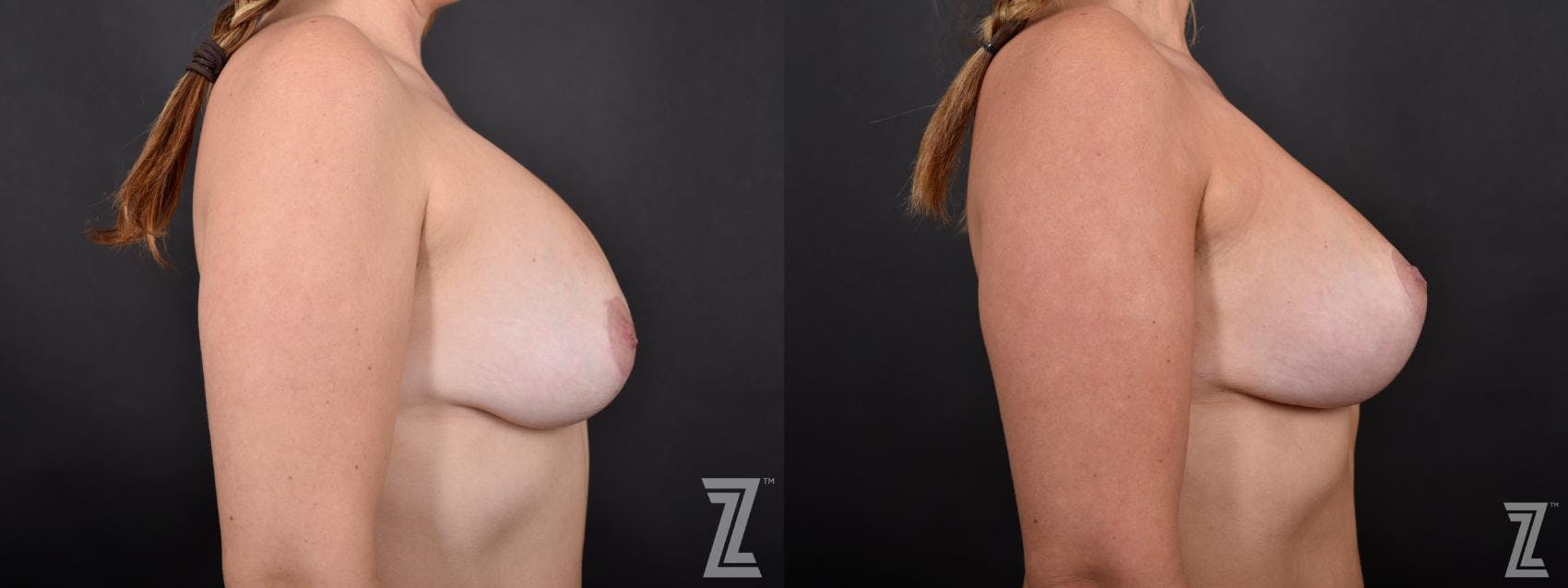 Breast Augmentation Revision Before & After Gallery - Patient 132793352 - Image 5