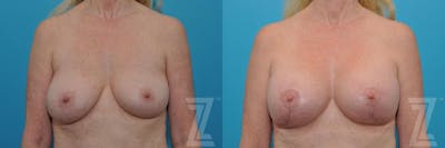 Austin Breast Augmentation Revision Before & After Gallery - Patient 132794909 - Image 1 - The Piazza Center