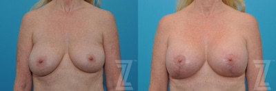 Breast Augmentation Revision Before & After Gallery - Patient 132794909 - Image 1