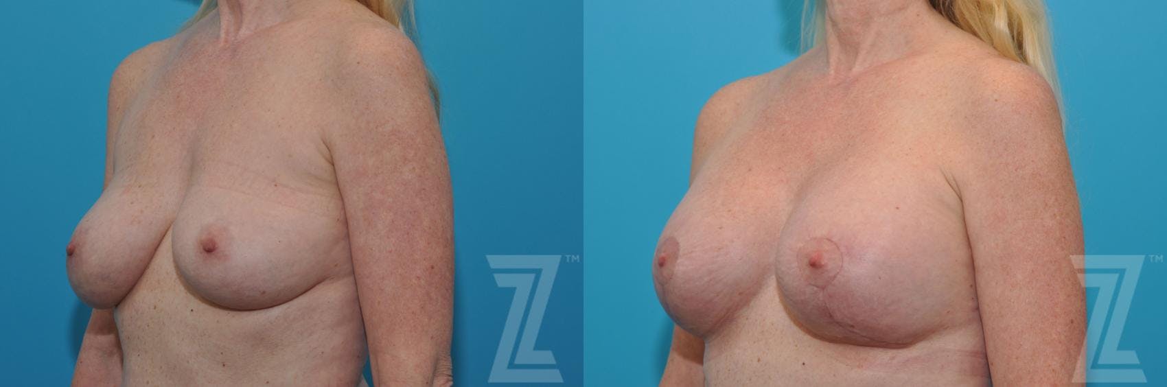 Breast Augmentation Revision Before & After Gallery - Patient 132794909 - Image 2