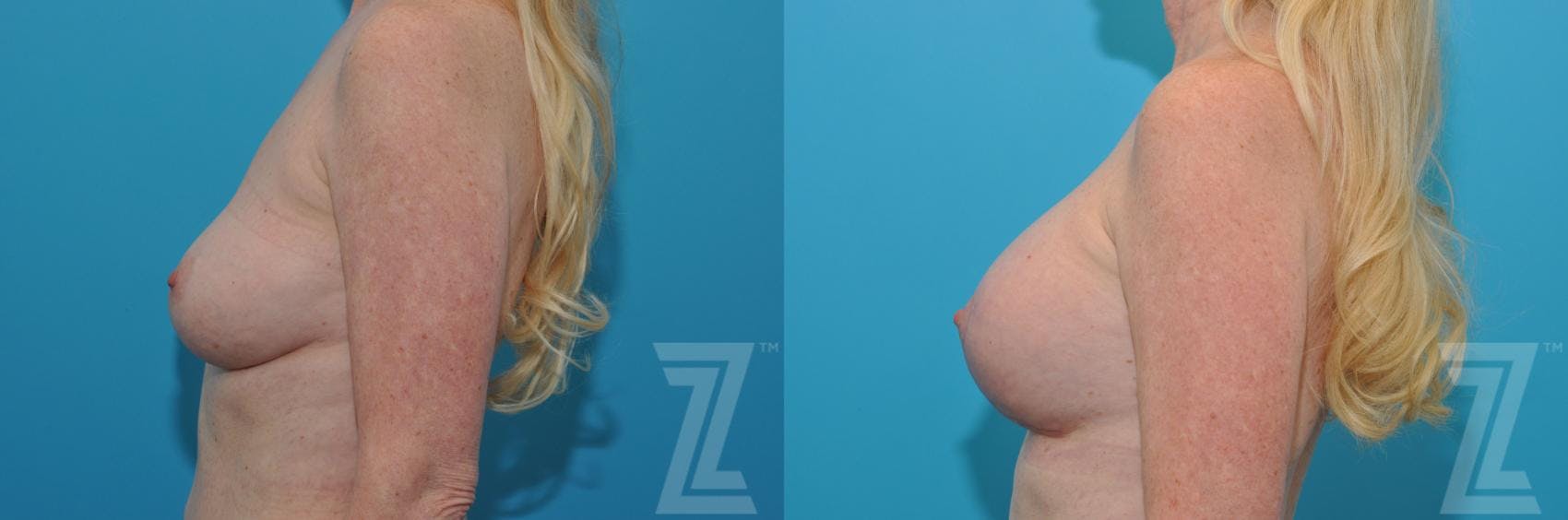 Breast Augmentation Revision Before & After Gallery - Patient 132794909 - Image 3