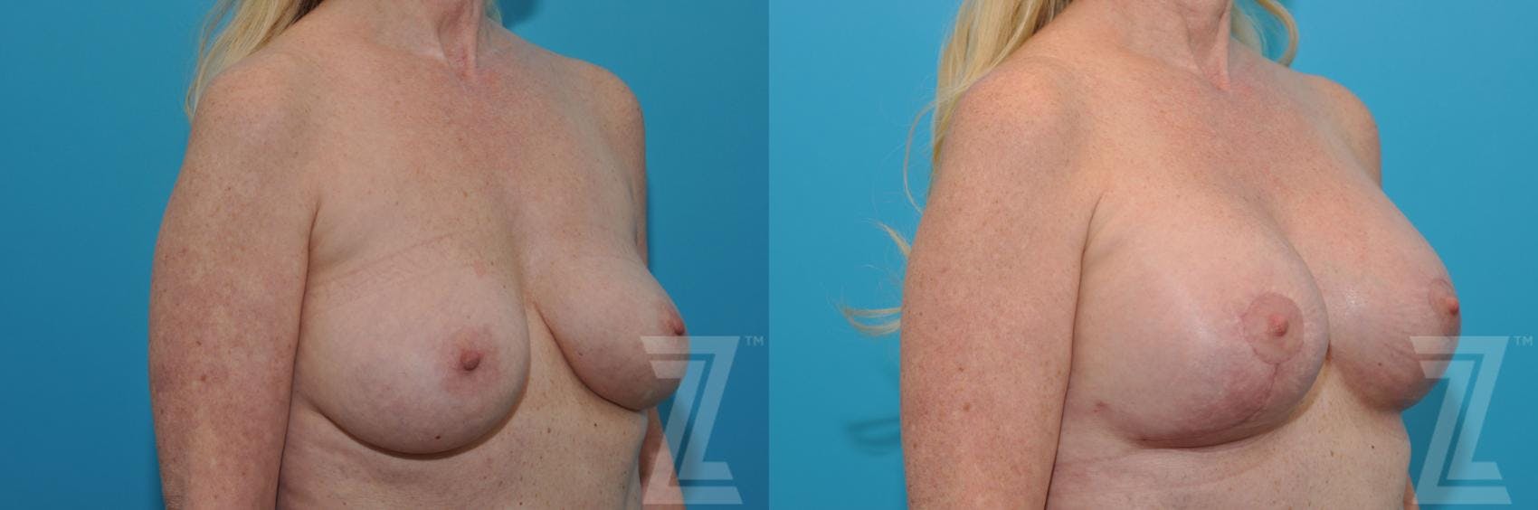 Breast Augmentation Revision Before & After Gallery - Patient 132794909 - Image 4