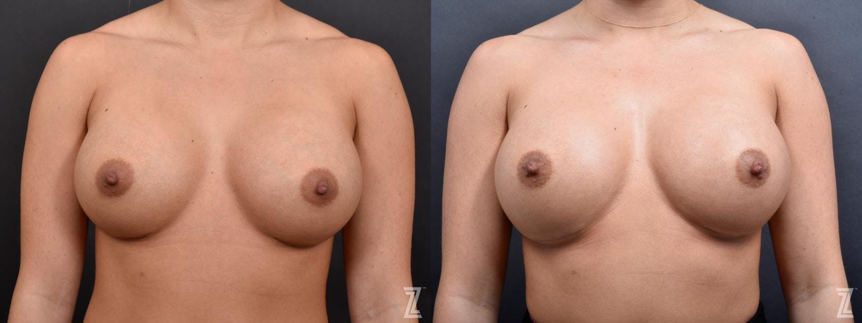 Breast Augmentation Revision Before & After Gallery - Patient 132880910 - Image 1