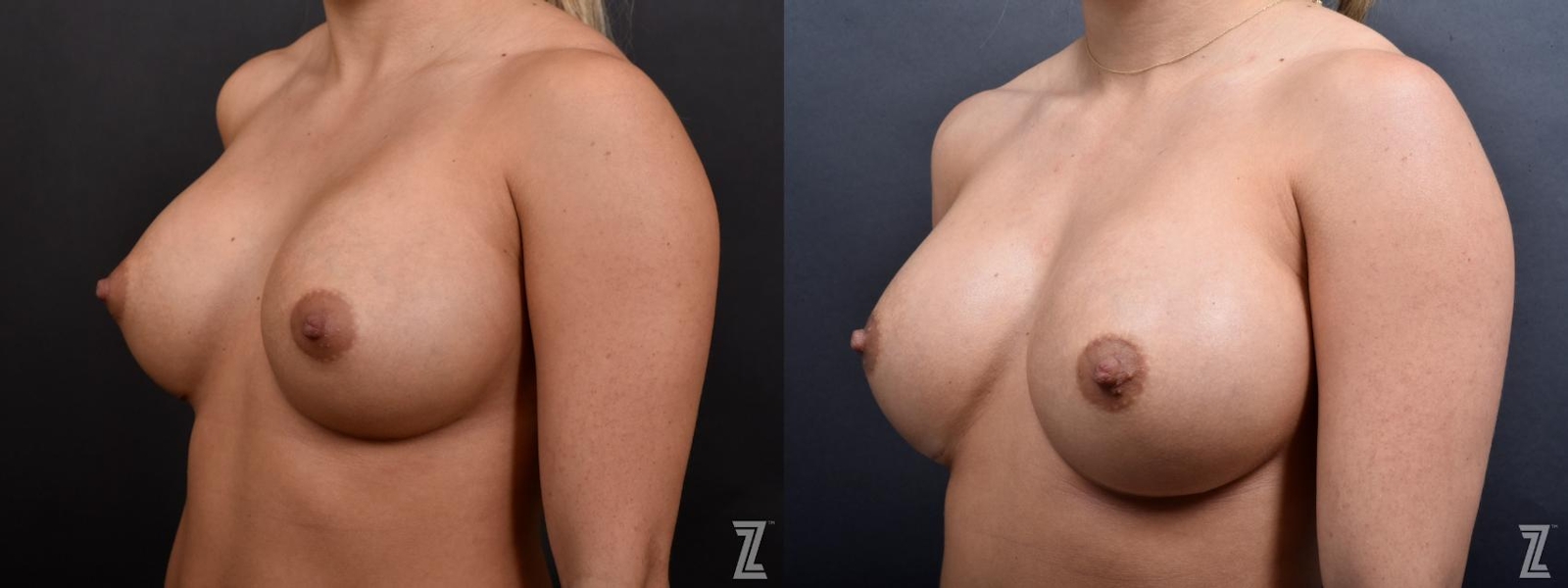 Austin Breast Augmentation Revision Before & After Gallery - Patient 132880910 - Image 2 - The Piazza Center