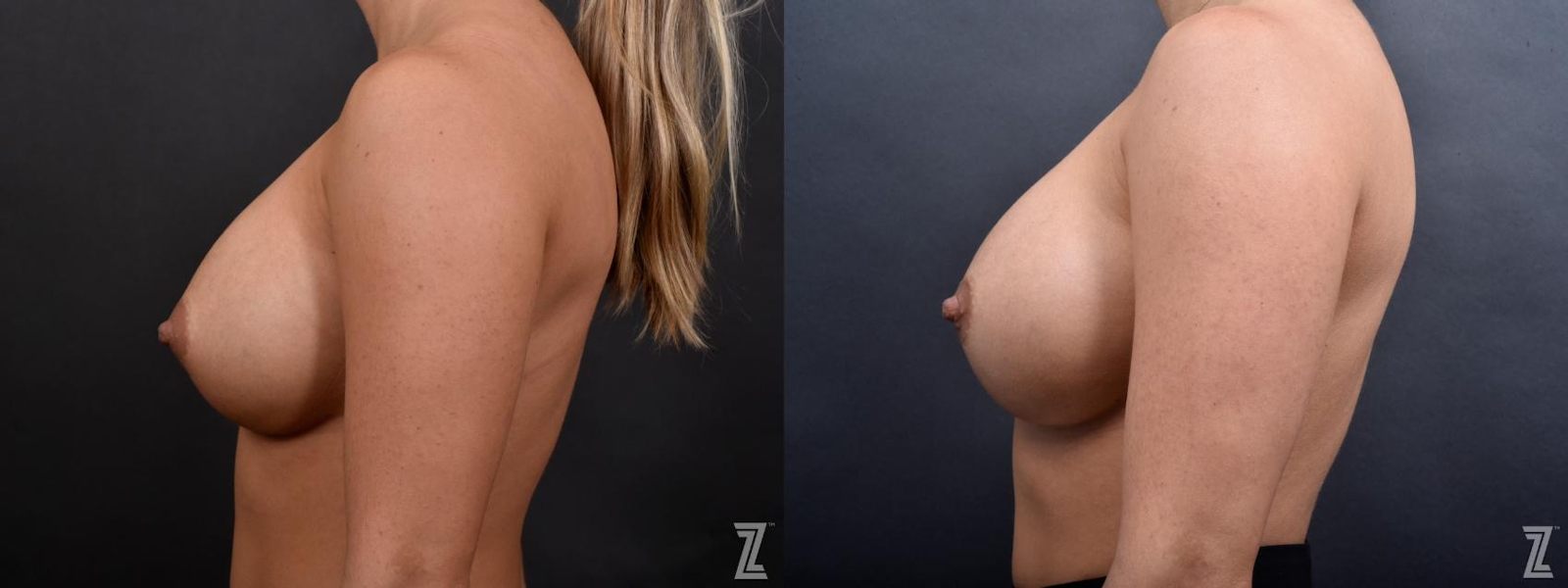 Austin Breast Augmentation Revision Before & After Gallery - Patient 132880910 - Image 3 - The Piazza Center