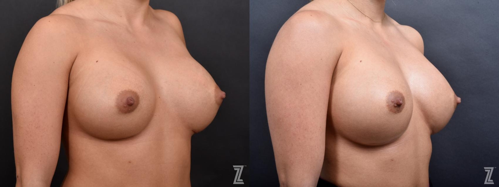 Austin Breast Augmentation Revision Before & After Gallery - Patient 132880910 - Image 4 - The Piazza Center