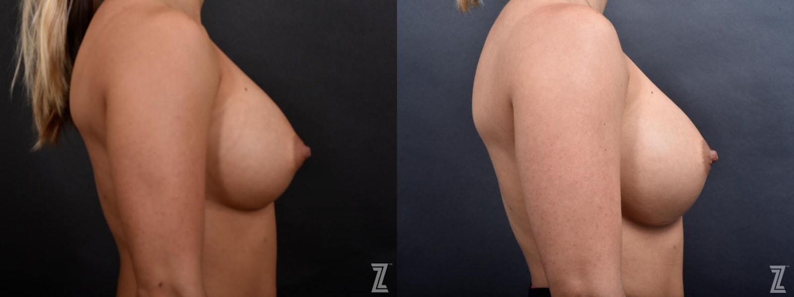 Austin Breast Augmentation Revision Before & After Gallery - Patient 132880910 - Image 5 - The Piazza Center