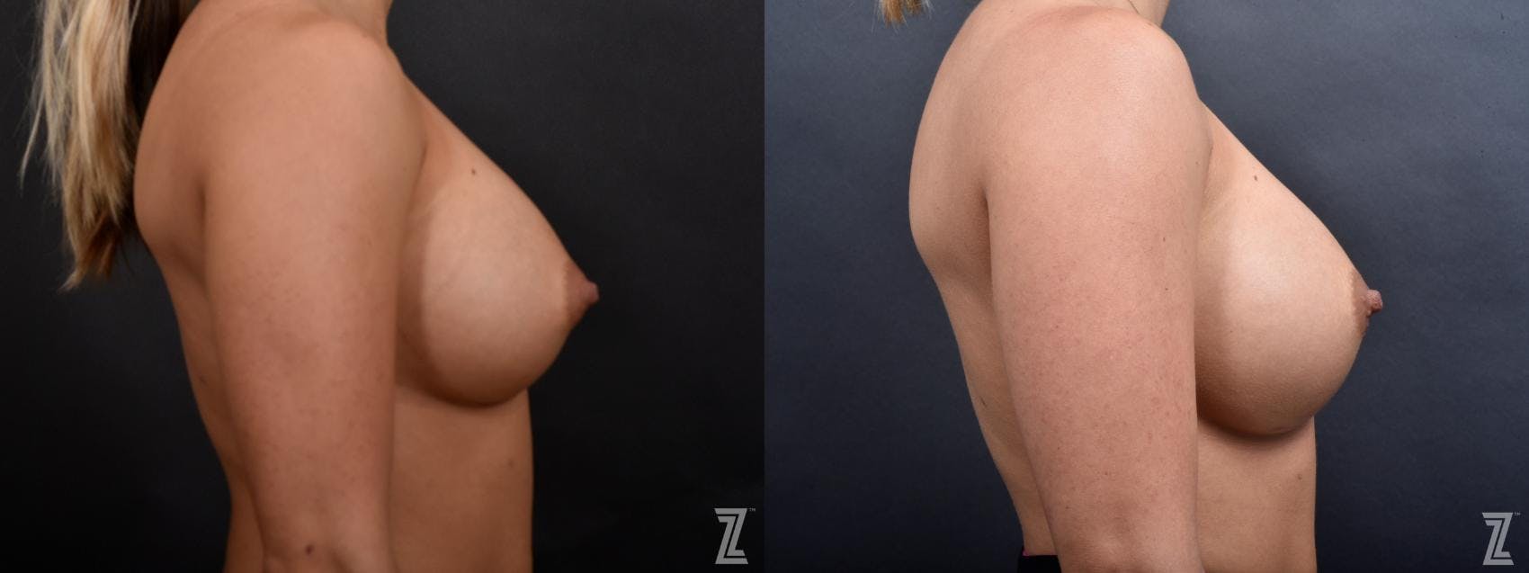 Breast Augmentation Revision Before & After Gallery - Patient 132880910 - Image 5