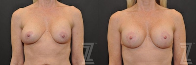 Breast Augmentation Revision Before & After Gallery - Patient 132886535 - Image 1