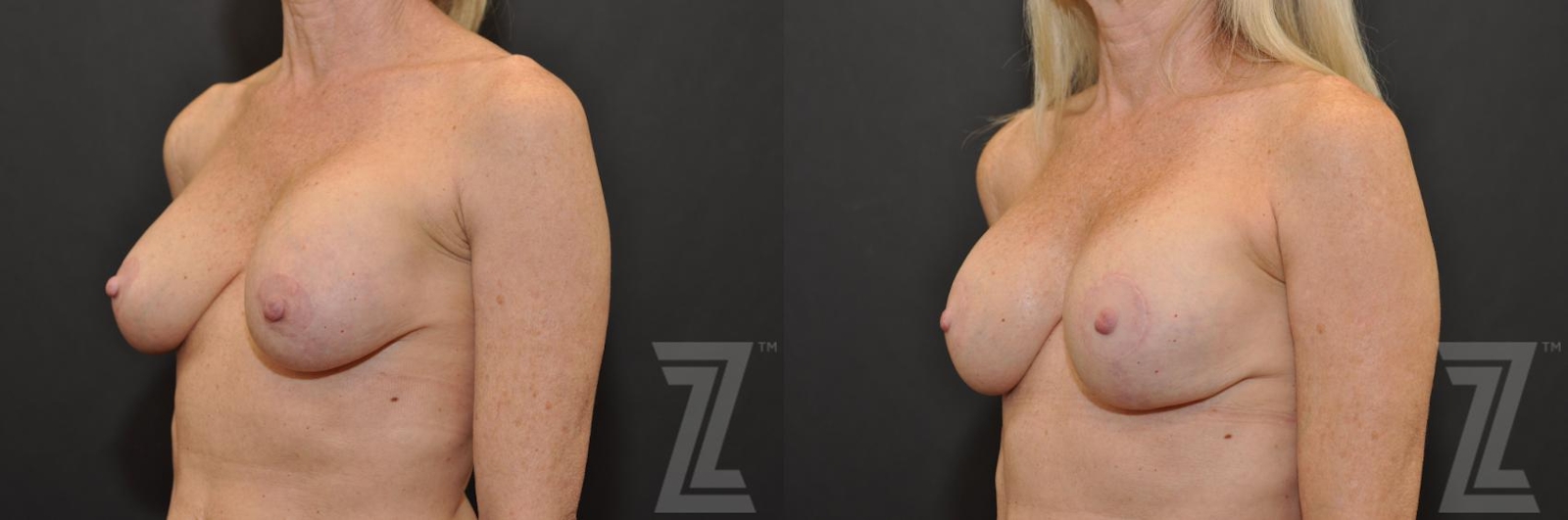 Austin Breast Augmentation Revision Before & After Gallery - Patient 132886535 - Image 2 - The Piazza Center
