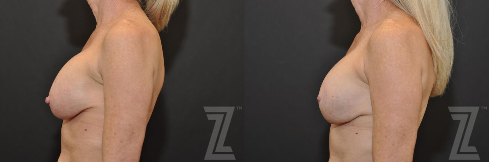 Austin Breast Augmentation Revision Before & After Gallery - Patient 132886535 - Image 3 - The Piazza Center