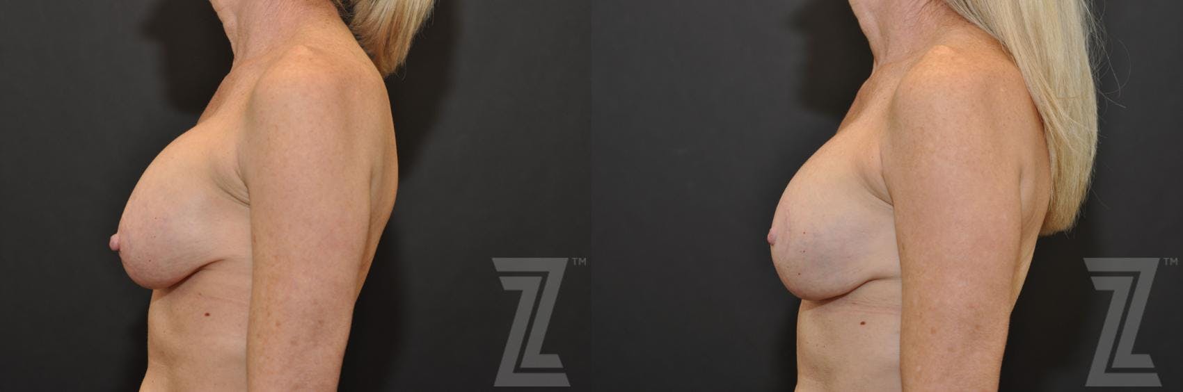 Breast Augmentation Revision Before & After Gallery - Patient 132886535 - Image 3