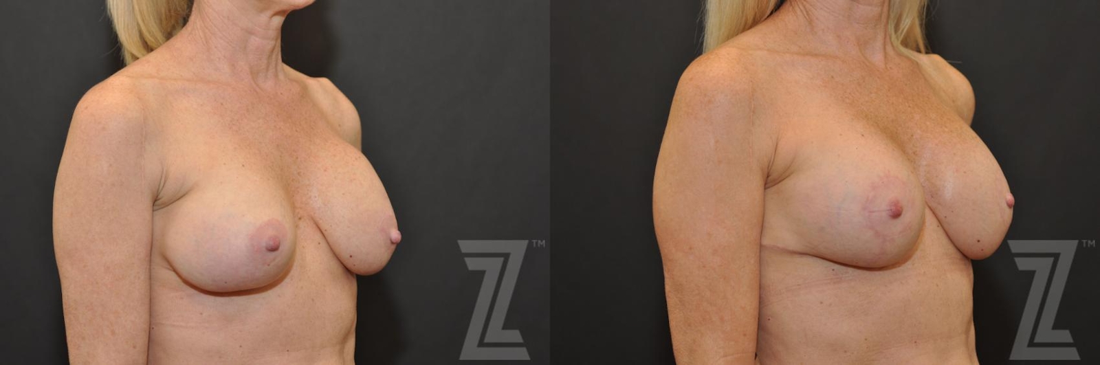 Austin Breast Augmentation Revision Before & After Gallery - Patient 132886535 - Image 4 - The Piazza Center