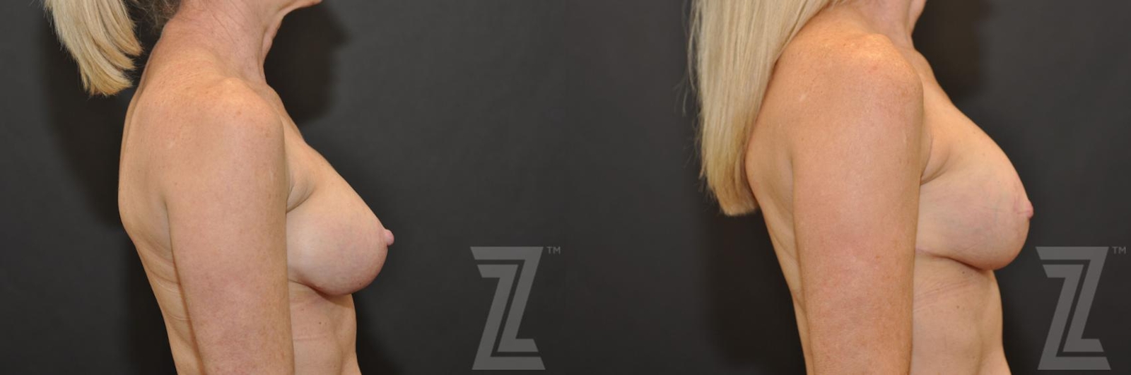 Austin Breast Augmentation Revision Before & After Gallery - Patient 132886535 - Image 5 - The Piazza Center