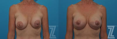 Austin Breast Augmentation Revision Before & After Gallery - Patient 132886537 - Image 1 - The Piazza Center