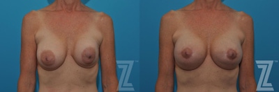 Breast Augmentation Revision Before & After Gallery - Patient 132886537 - Image 1