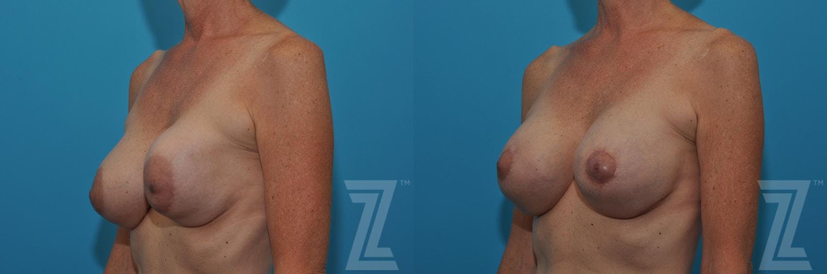 Breast Augmentation Revision Before & After Gallery - Patient 132886537 - Image 2